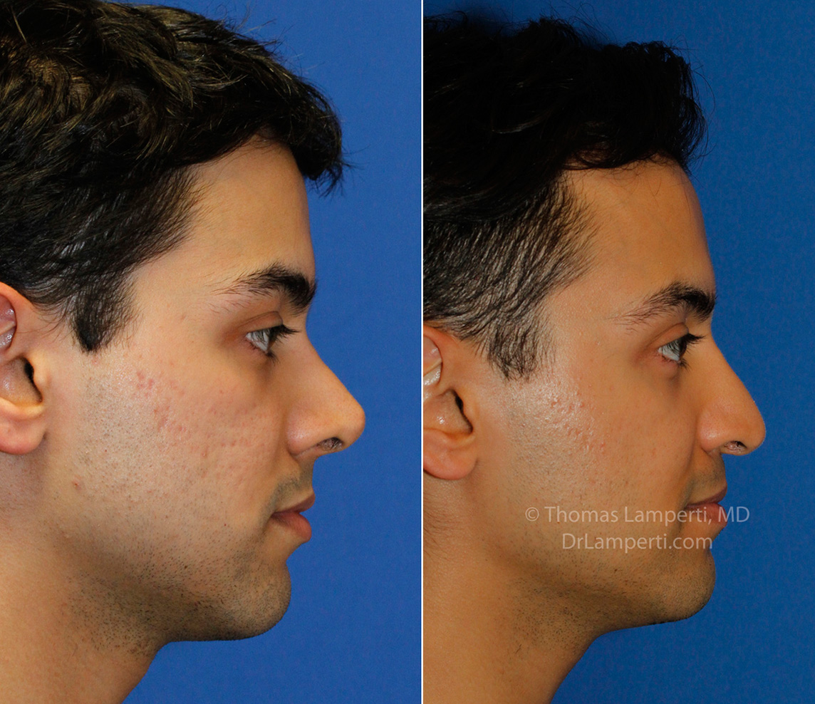 The Ultimate Solution for a Sleeker Jawline: Double Chin Liposuction in New York City      